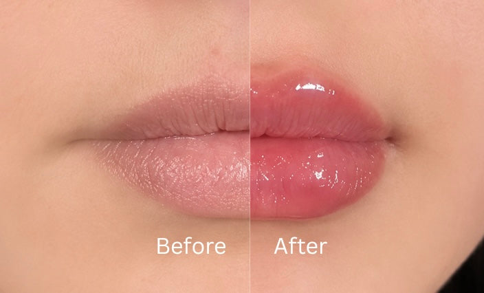LIP FILLER