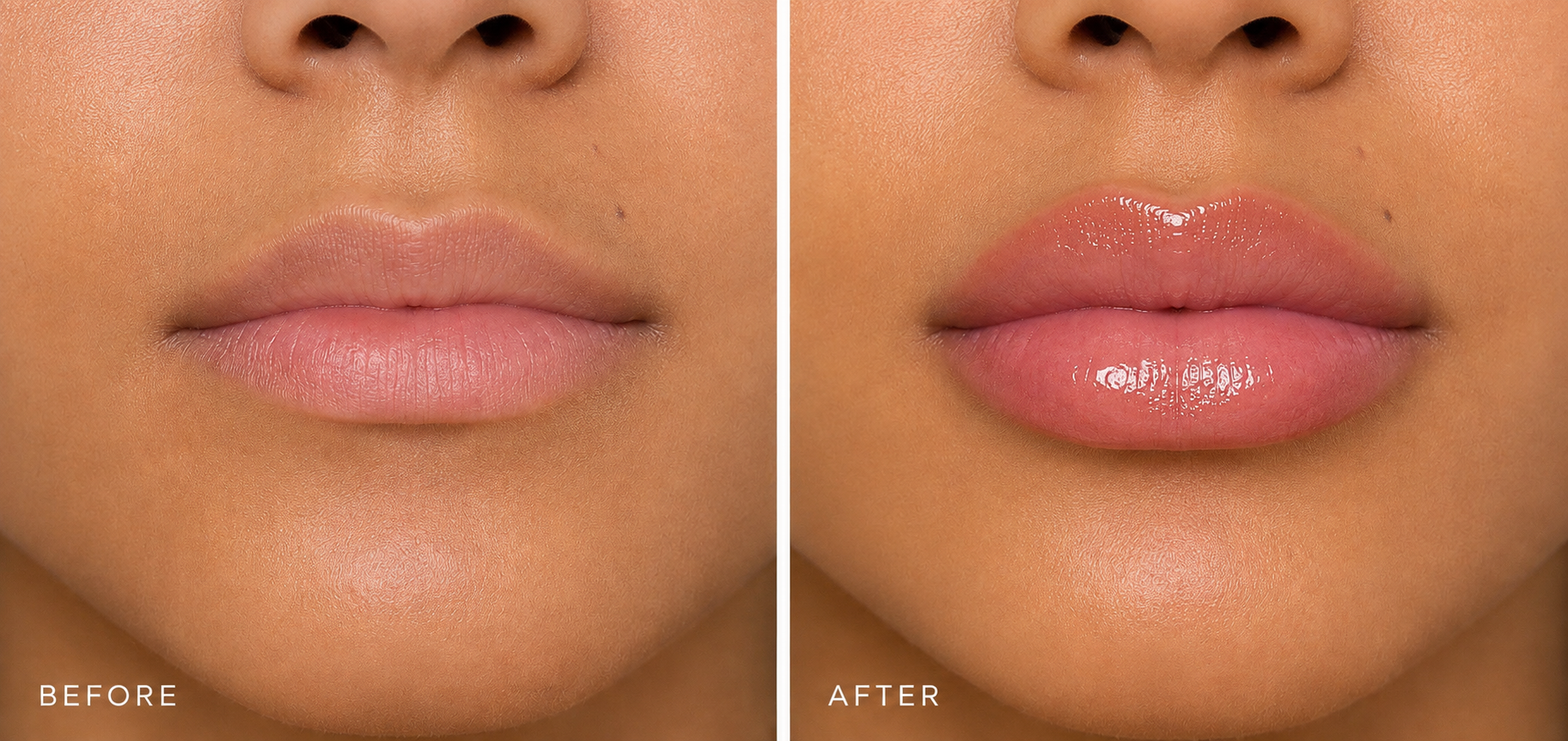 LIP FILLER