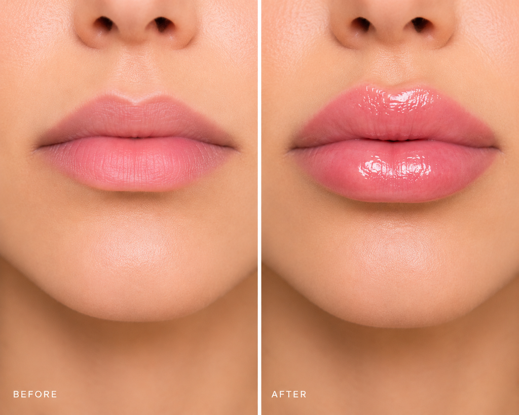 LIP FILLER