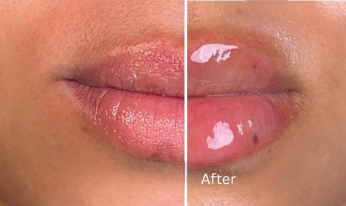 LIP FILLER